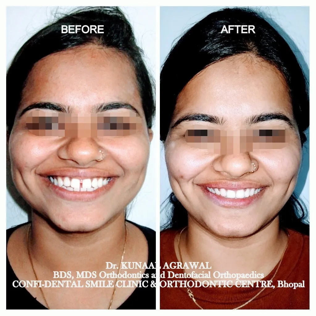 braces before and after bhopal 2